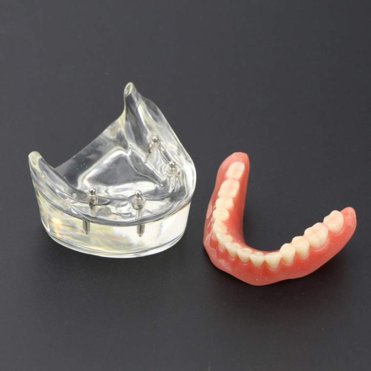 Modelo Sobre Dentadura Implantes Novedad Enseñanza Santiago 2