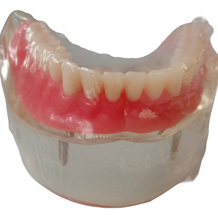 Modelo Sobre Dentadura Implantes Novedad Enseñanza Santiago 3