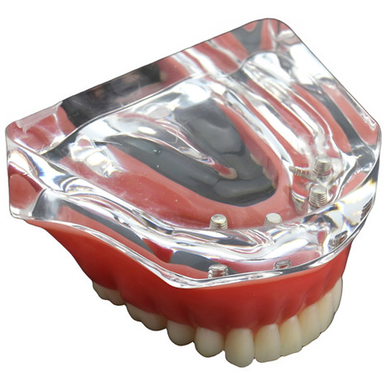 Modelo Sobre Dentadura Implantes Novedad Enseñanza Santiago 9