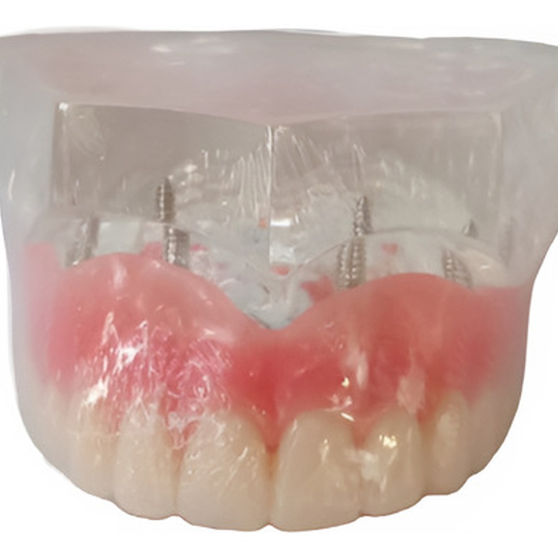 Modelo Sobre Dentadura Implantes Novedad Enseñanza Santiago 11
