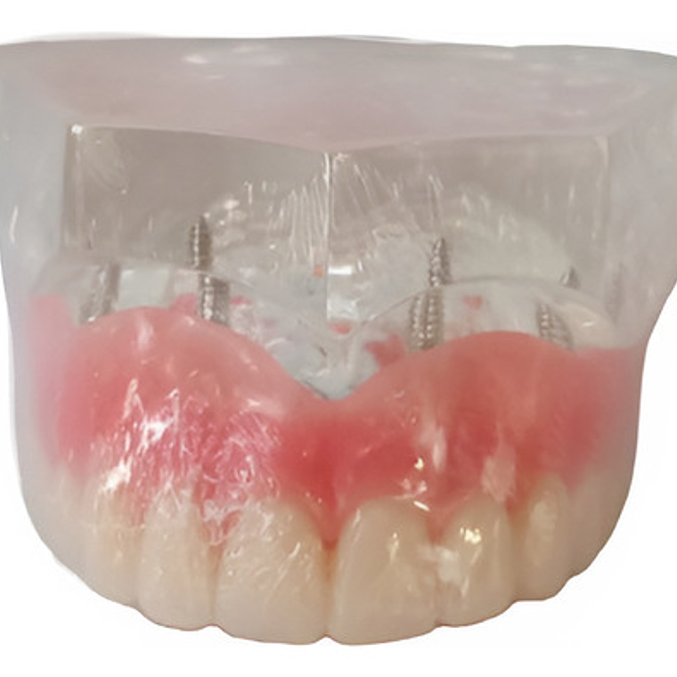 Modelo Sobre Dentadura Implantes Novedad Enseñanza Santiago 11