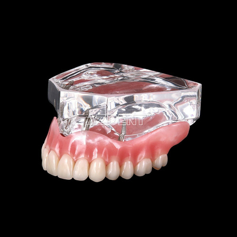 Modelo Sobre Dentadura Implantes Novedad Enseñanza Santiago 13