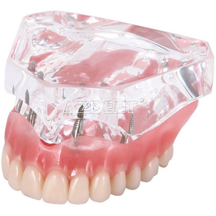 Modelo Sobre Dentadura Implantes Novedad Enseñanza Santiago 16