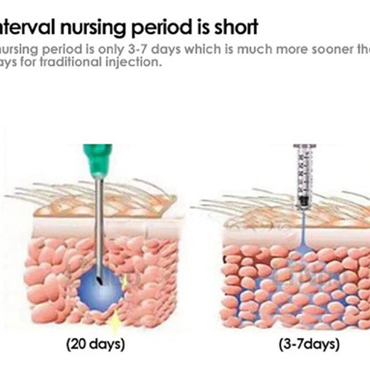 Hyaluron Pen Lápiz Hialurónico Alta Presión Calidad Santiago 7