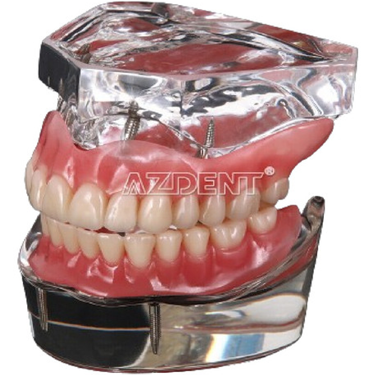 2 Modelos Sobre Dentadura Implantes Enseñanza Santiago 1