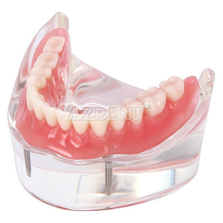 2 Modelos Sobre Dentadura Implantes Enseñanza Santiago 9