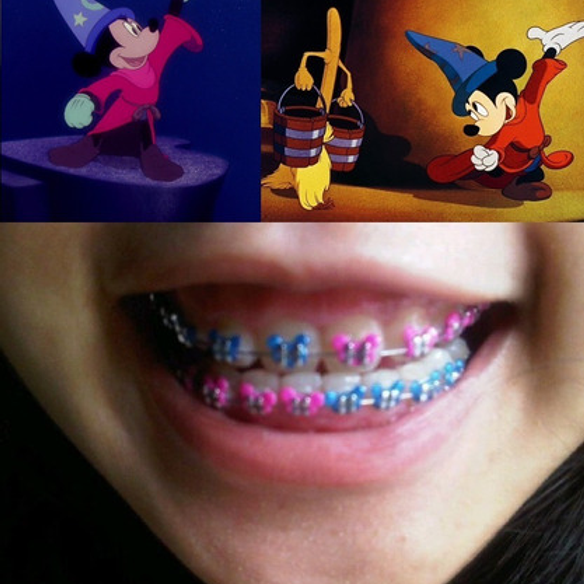 Ligaduras Ortodoncia De Mickey Mouse Colores 1000u Santiago 1