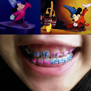 Ligaduras Ortodoncia De Mickey Mouse Colores 1000u Santiago