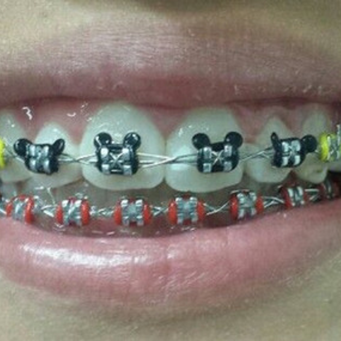 Ligaduras Ortodoncia De Mickey Mouse Colores 1000u Santiago 4