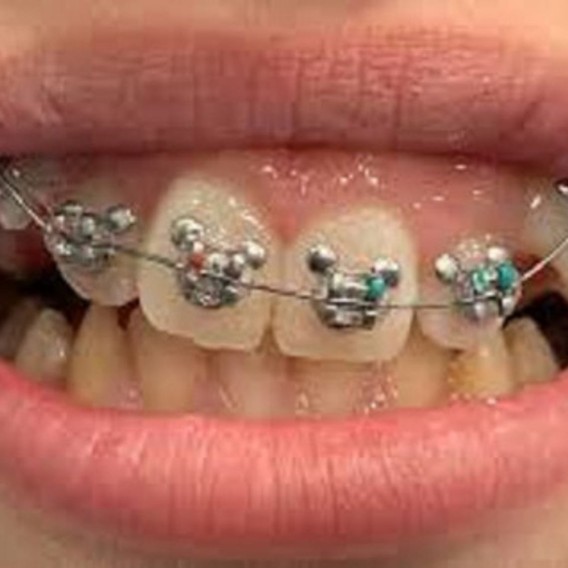 Ligaduras Ortodoncia De Mickey Mouse Colores 1000u Santiago 5