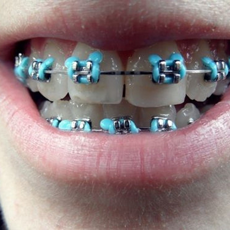 Ligaduras Ortodoncia De Mickey Mouse Colores 1000u Santiago 6