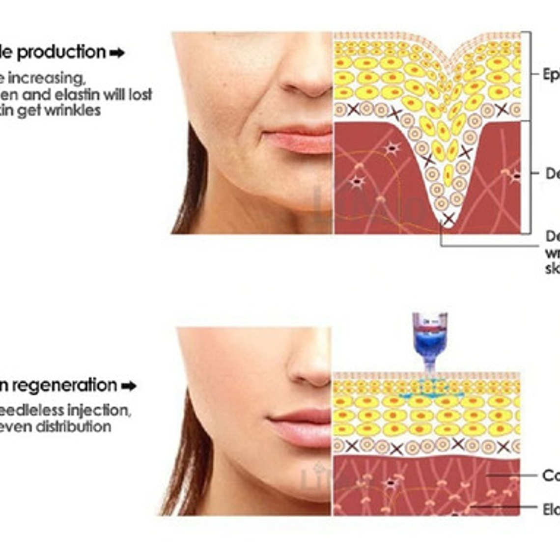 Hyaluron Pen Lápiz Hialurónico Alta Presión 2 En 1 Santiago 7