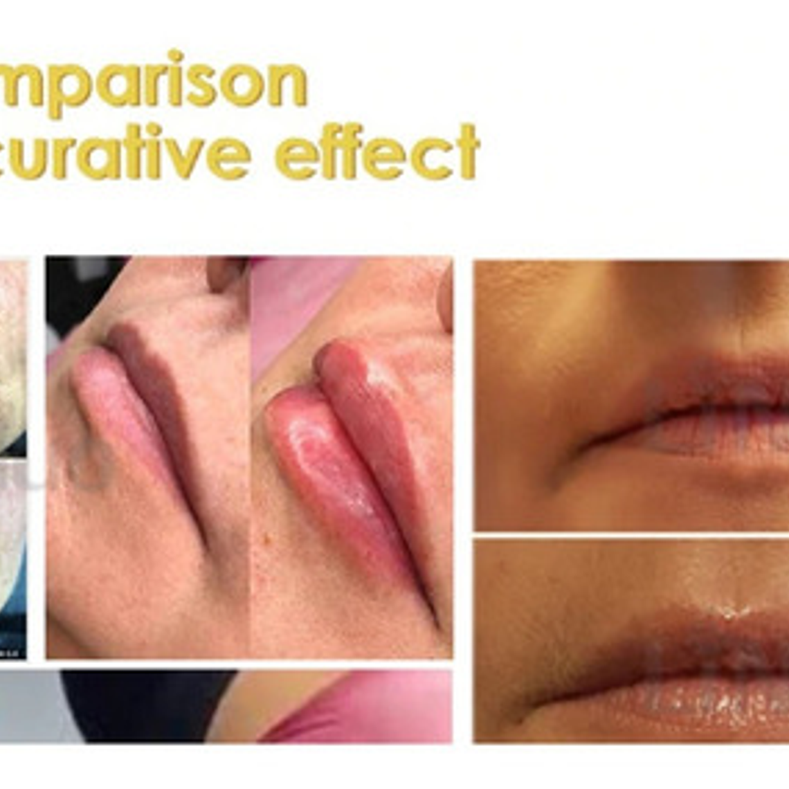 Hyaluron Pen Lápiz Hialurónico Alta Presión 2 En 1 Santiago 8