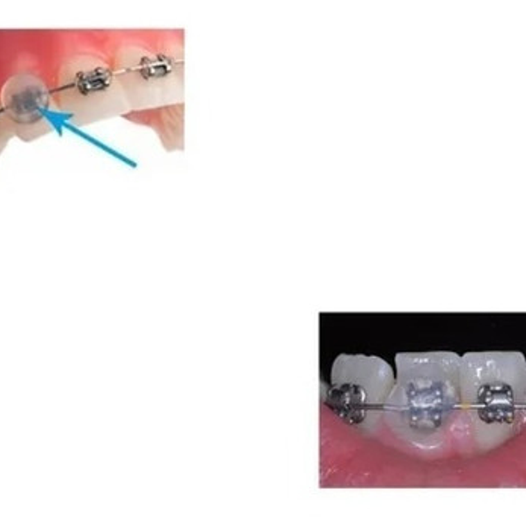 Cera Ortodoncia 5 Packs - Alivio Para Tu Boca Santiago 4