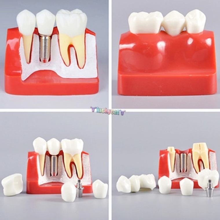 Modelo Dental Enseñanza Y Estudio Puente Gigante Santiago 2