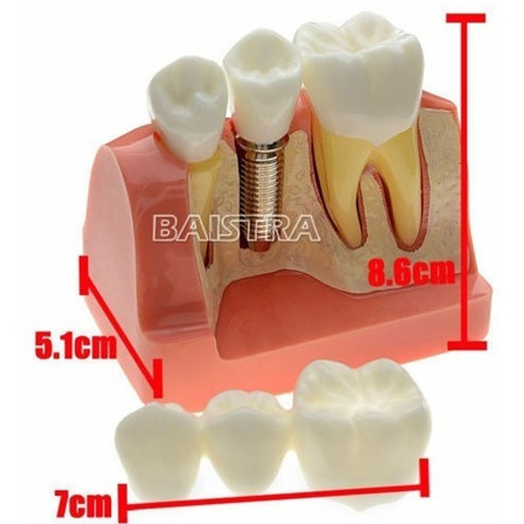 Modelo Dental Enseñanza Y Estudio Puente Gigante Santiago 3
