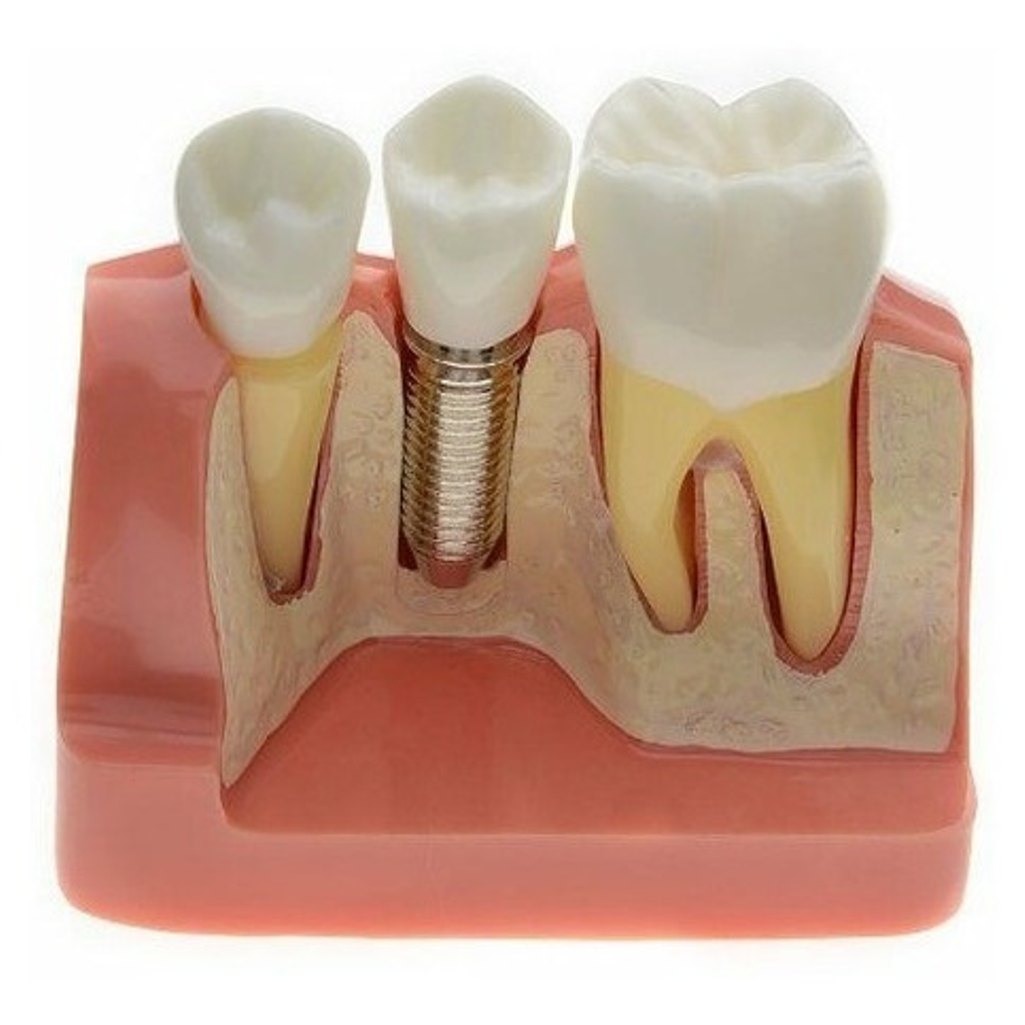 Modelo Dental Enseñanza Y Estudio Puente Gigante Santiago 5