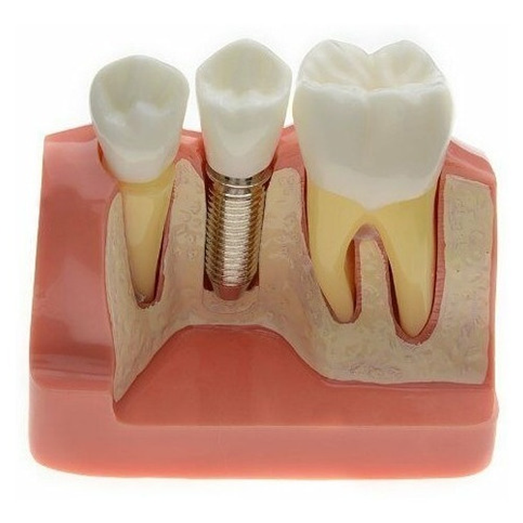 Modelo Dental Enseñanza Y Estudio Puente Gigante Santiago 5