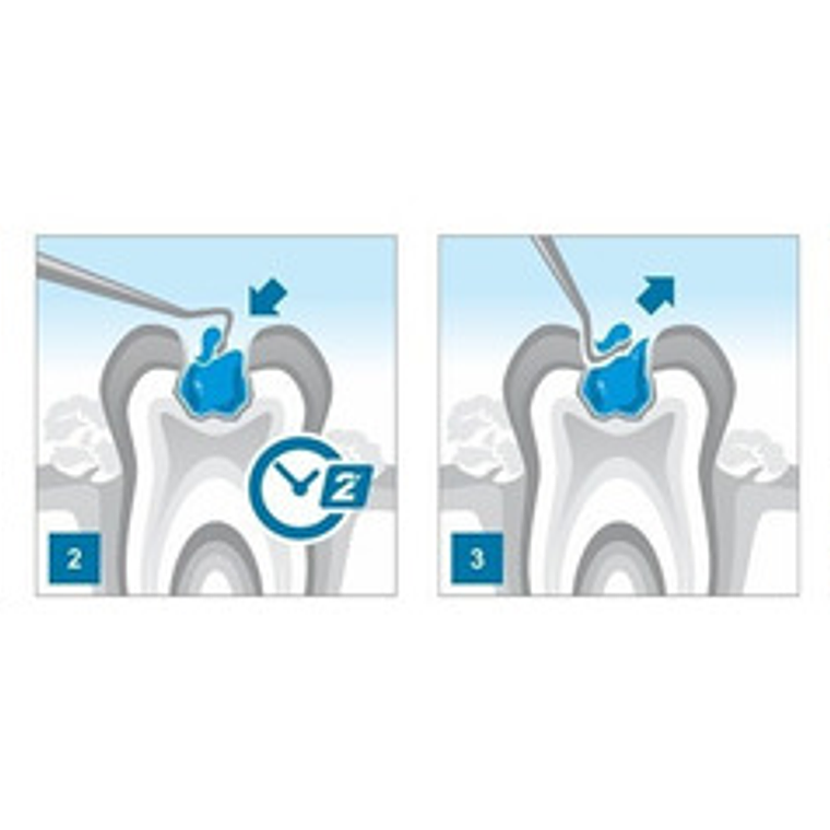 Brix 3000 Odontologia Gel 3grs. Remoción Atraumática Caries 4