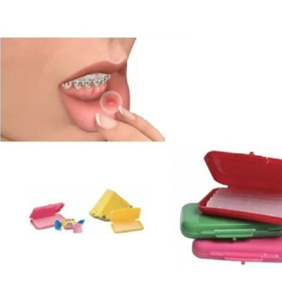 Cera Para Bracket Ortodoncia Pack 3 Cajas Santiago 6