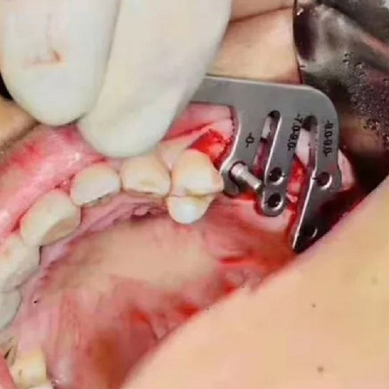 Reglas De Medición Para Implantes Dentales Guía Set Santiago 4