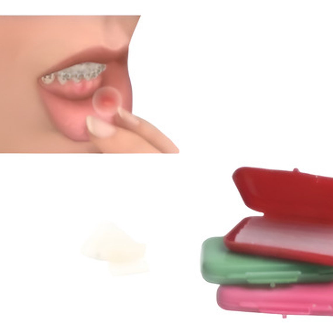 Cera De Alivio Para Bracket 2 Cajitas Santiago 1