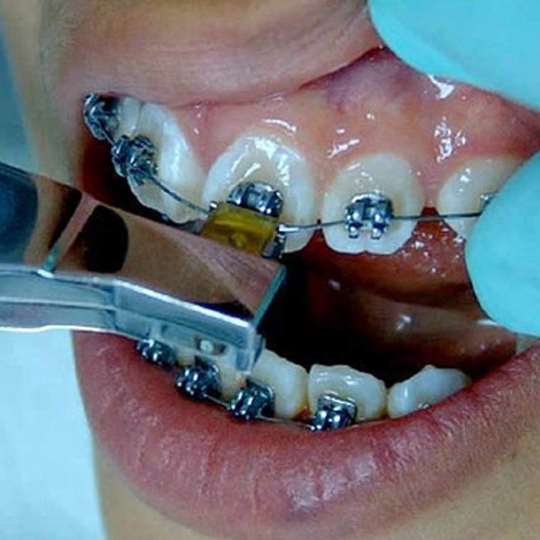 Arcos Curva Reversa Niti Super Elástico Ortodoncia 2u/sobre 16