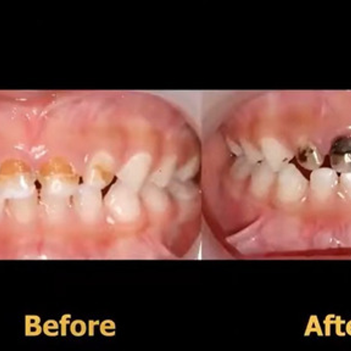 Fagamín Fluoruro Diamino Plata Dental 5ml Santiago 4