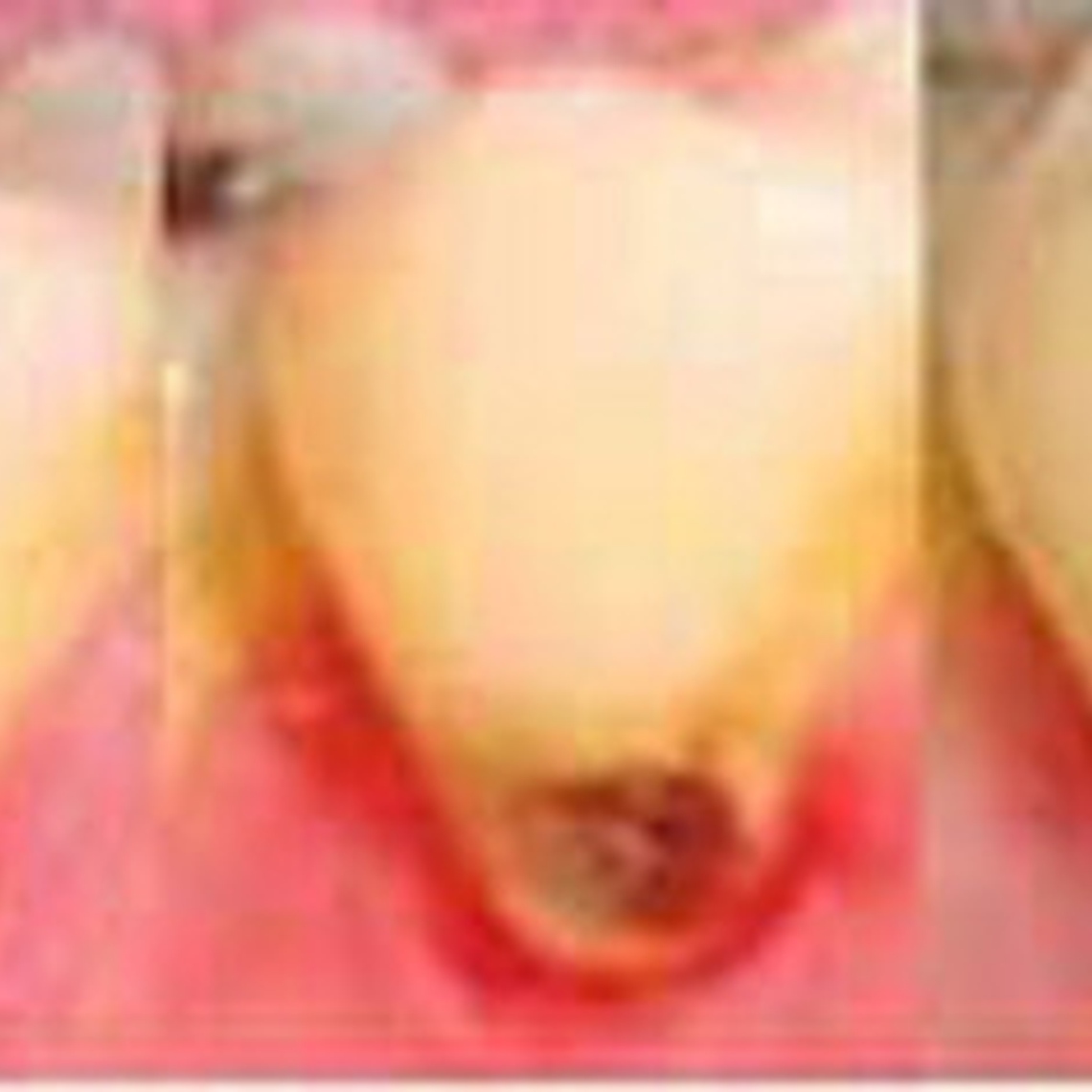 Fagamín Fluoruro Diamino Plata Dental 5ml Santiago 5