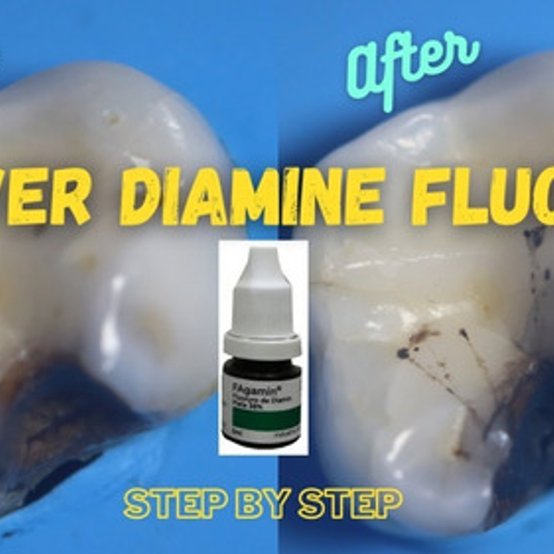 Fagamín Fluoruro Diamino Plata Dental 5ml Santiago 7