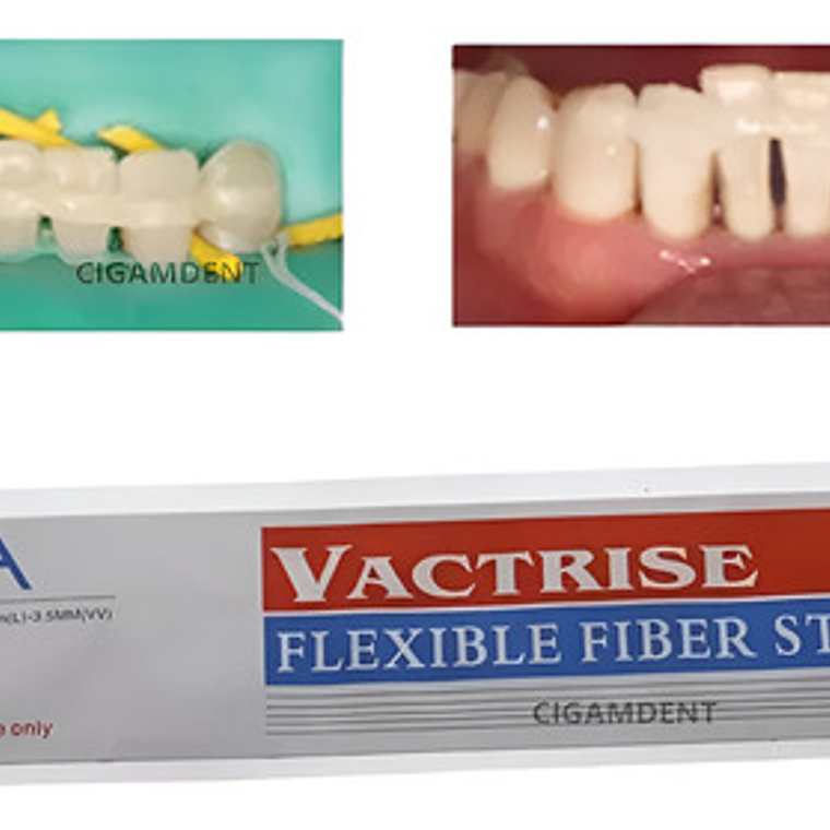 Banda De Refuerzo Dental Tira De Fibra Tipo Ribbond Calidad 1