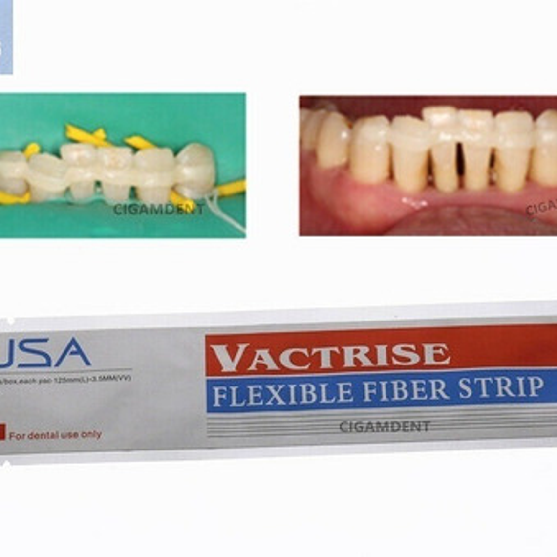 Banda De Refuerzo Dental Tira De Fibra Tipo Ribbond Calidad 4