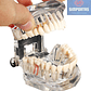 Modelo Dental Enseñanza Y Tratamientos Implantes Protesis - Miniatura 3