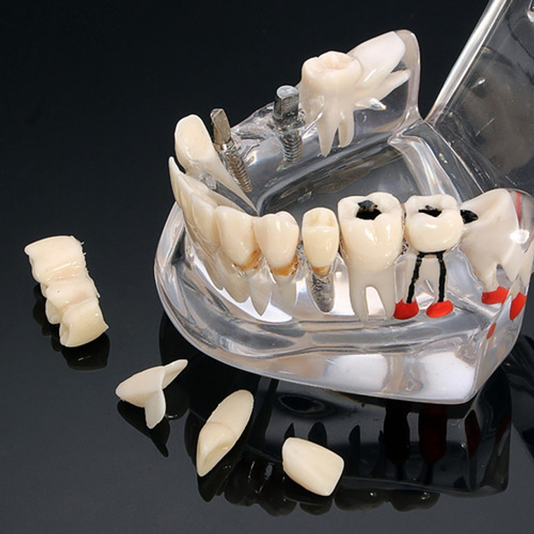 Modelo Dental Enseñanza Y Tratamientos Implantes Protesis 5