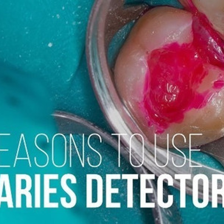 Redamín Detector De Caries Dental 5ml Uso Profesional Stgo. 2