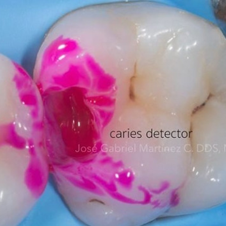 Redamín Detector De Caries Dental 5ml Uso Profesional Stgo. 3