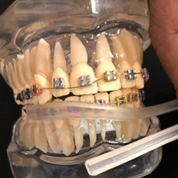 Protección Para Ortodoncia Bracket Protege Labios Y Mejillas 7