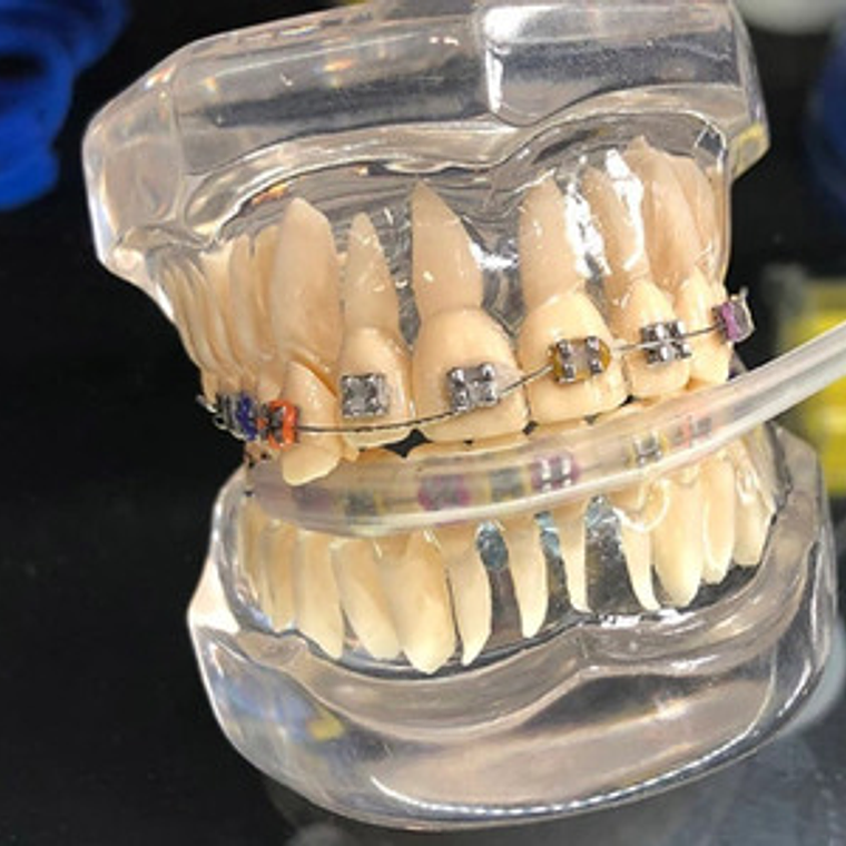 Protección Para Ortodoncia Bracket Protege Labios Y Mejillas 5