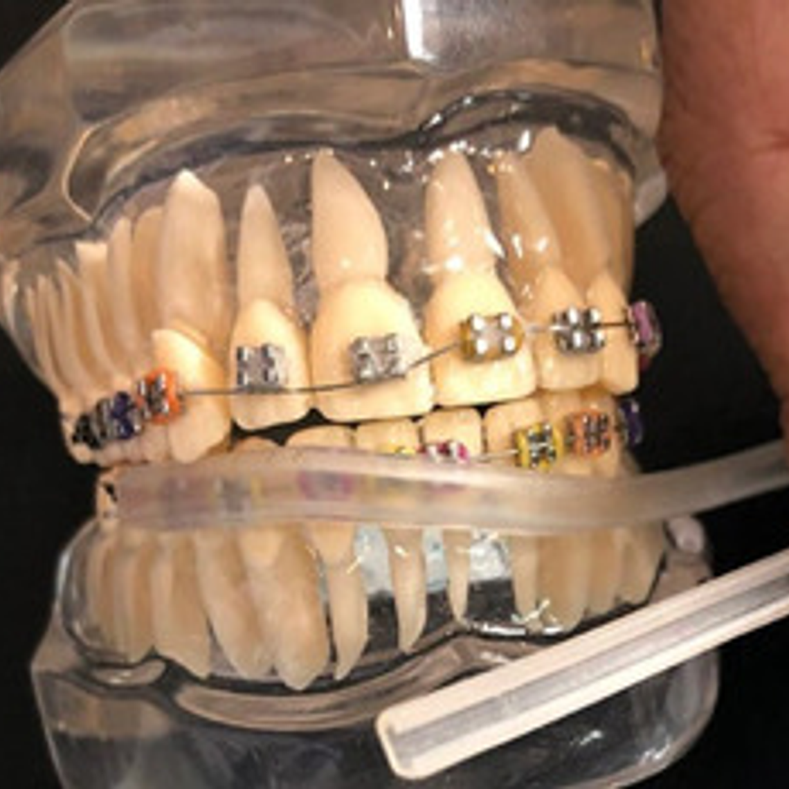 Protección Para Ortodoncia Bracket Protege Labios Y Mejillas 8