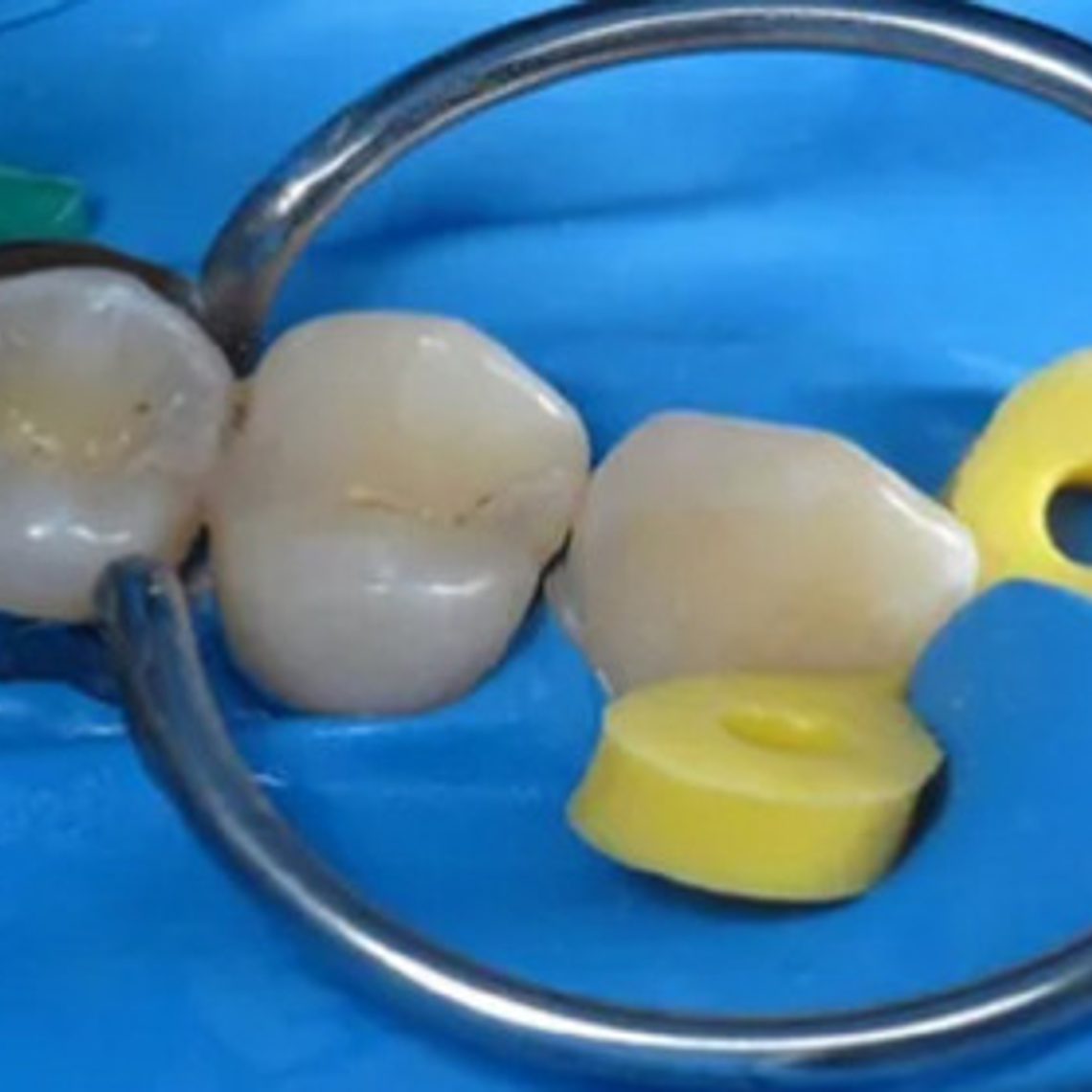 Banda Matrices Preformadas Odontología Anillo 100u Santiago 7