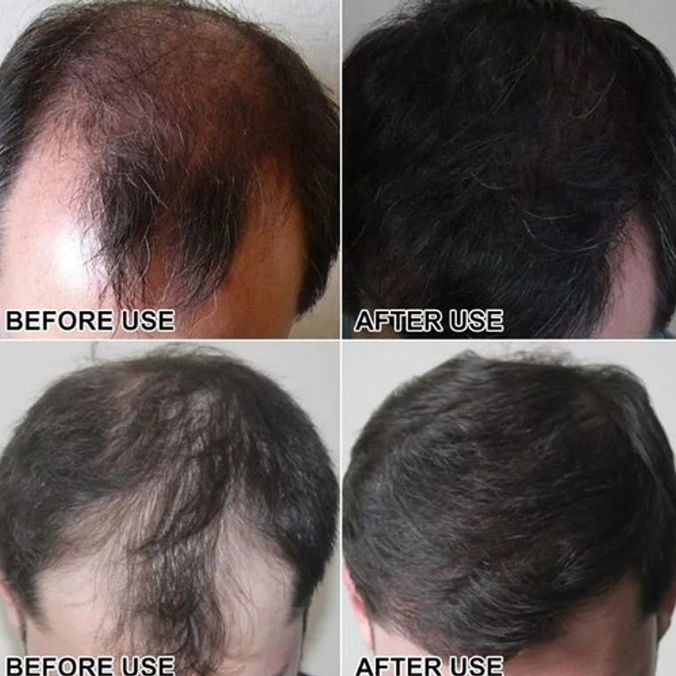 Fibras Sevich Naturales Relleno Calvicie Colores 25g Stgo. 7