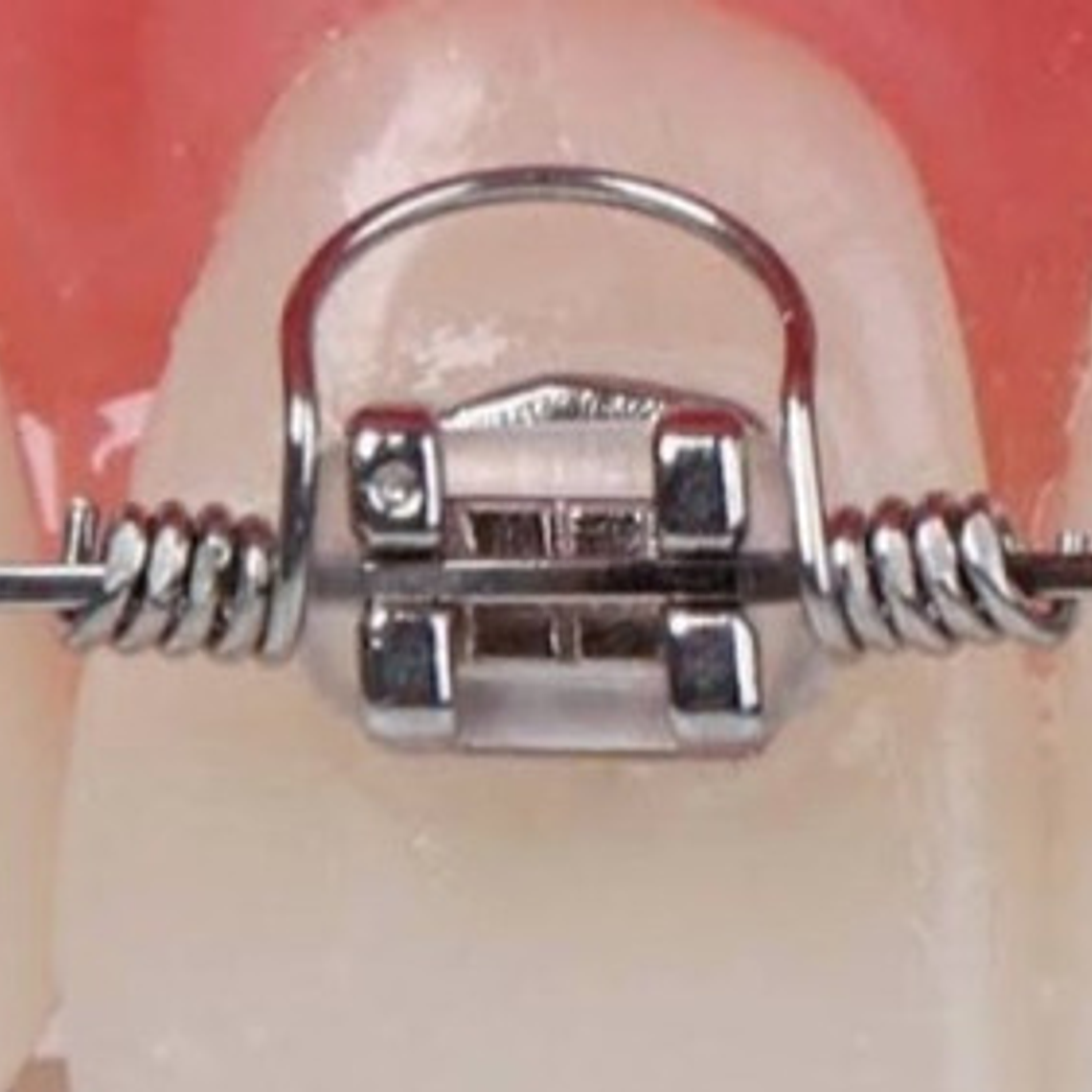 Resorte De Torsión Ortodoncia Pack 10 Unidades Medidas Stgo. 1