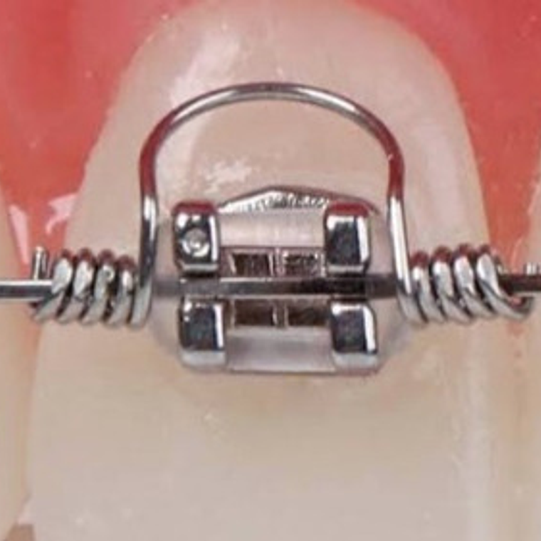 Resorte De Torsión Ortodoncia Pack 10 Unidades Medidas Stgo. 1