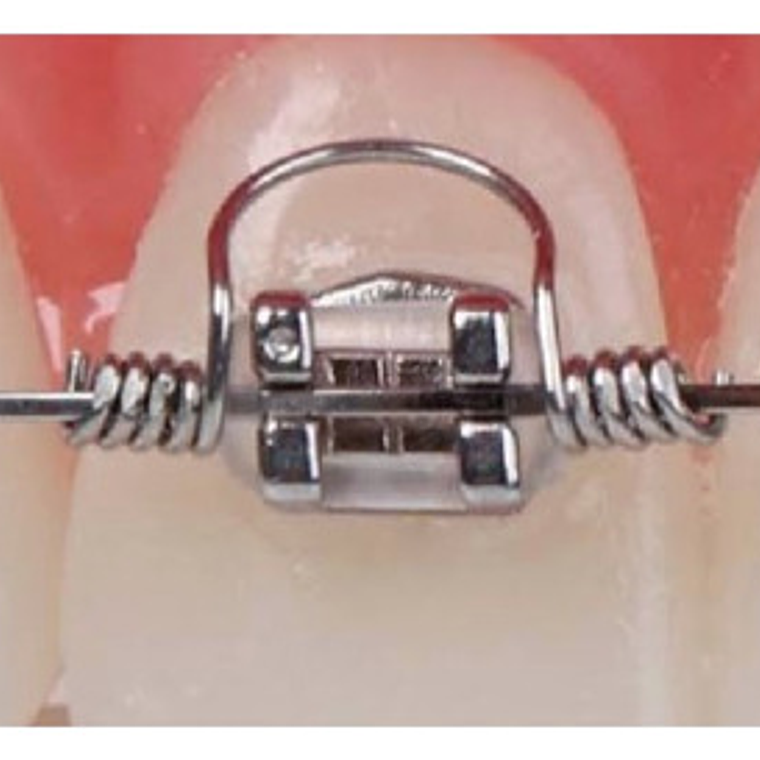 Resorte De Torsión Ortodoncia Pack 10 Unidades Medidas Stgo. 7