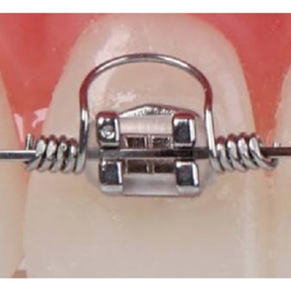 Resorte De Torsión Ortodoncia Pack 10 Unidades Medidas Stgo. 13