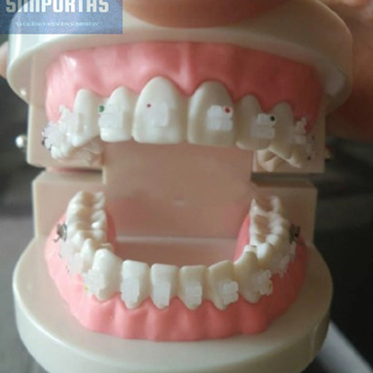 Modelo Ortodoncia Enseñanza Estéticos Autoligados Santiago 2