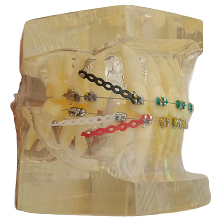 Modelo Dental Ortodoncia Brackets Normal Acrílico Transp. 2