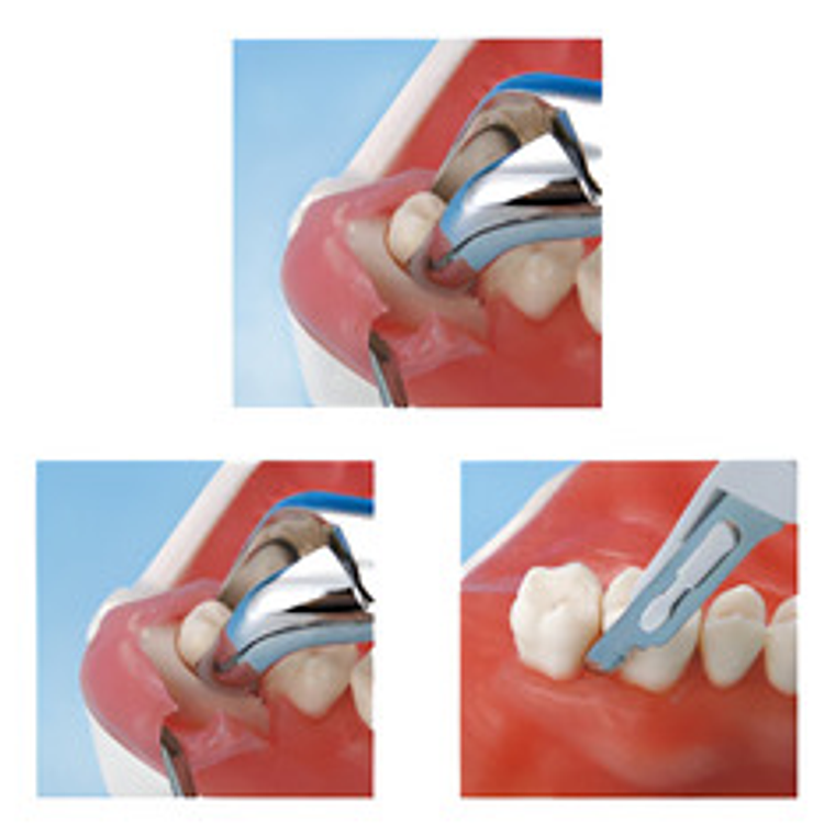 Modelo Anatómico Bucal Cirugía Oral Colgajos Quiste Incluido 3