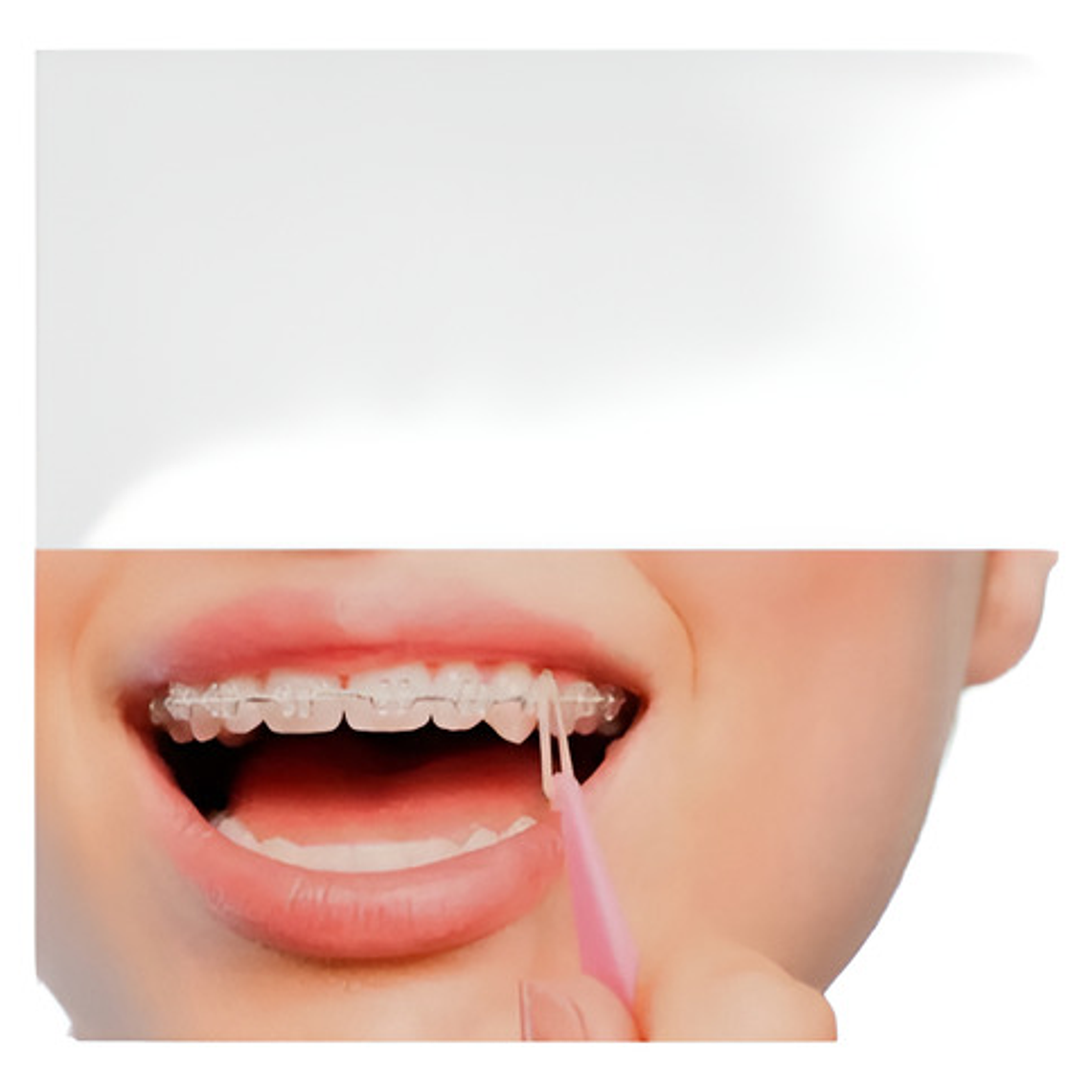 Posicionador Elásticos Intermaxilares Ortodoncia X 50 Stgo 3