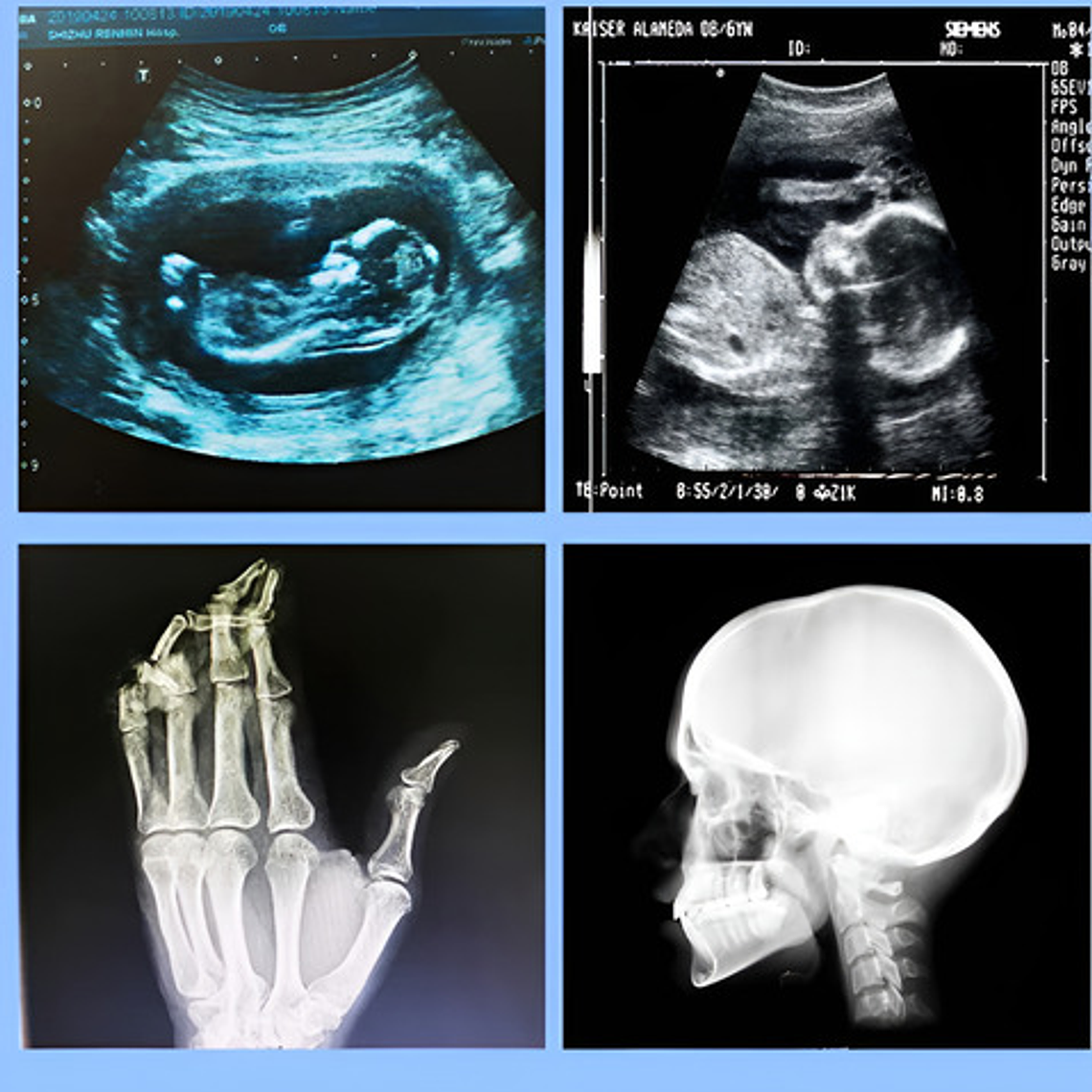 Pack 5 Papel Térmico Upp-110hg Para Impresora Sony 2